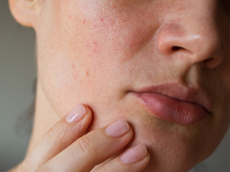 visage avec peau irritée