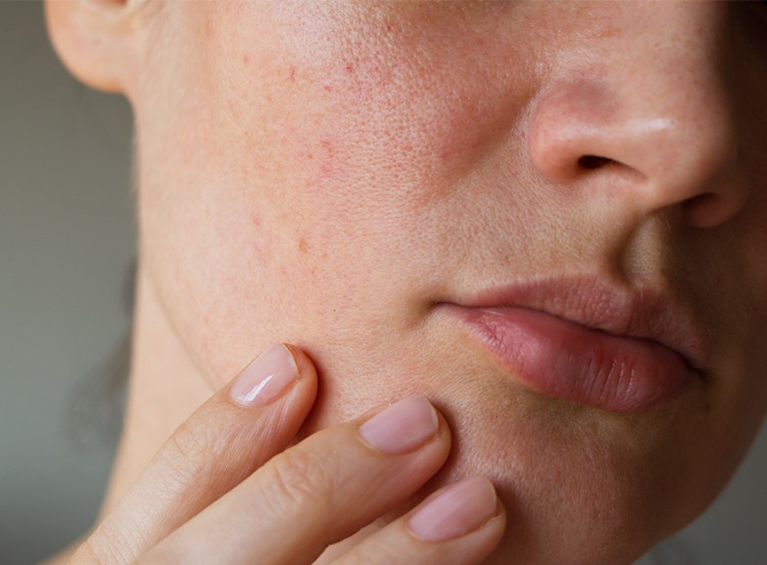 visage avec peau irritée