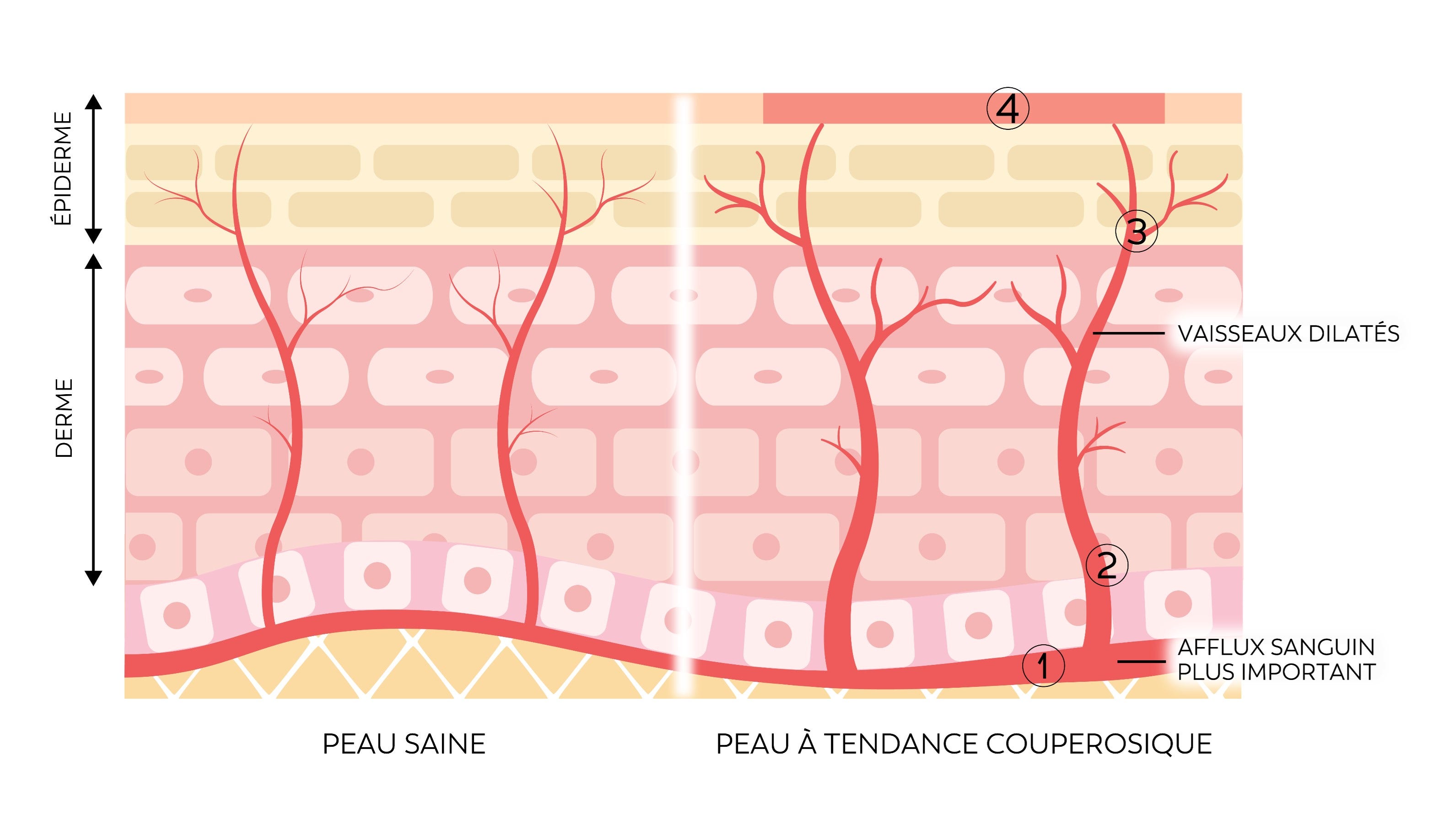 Infographie des causes des peaux couperosique